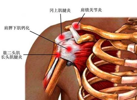 肩周炎三个动作自愈方法(患了肩周炎真的不好受)-第1张图片 肩周炎三个动作自愈方法(患了肩周炎真的不好受)-第1张图片