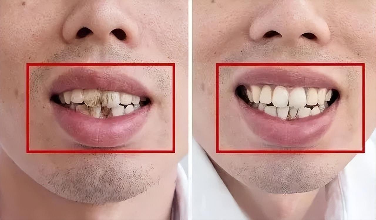 为什么人都后悔洗牙（哪些患者是不适合进行洗牙的）-第7张图片