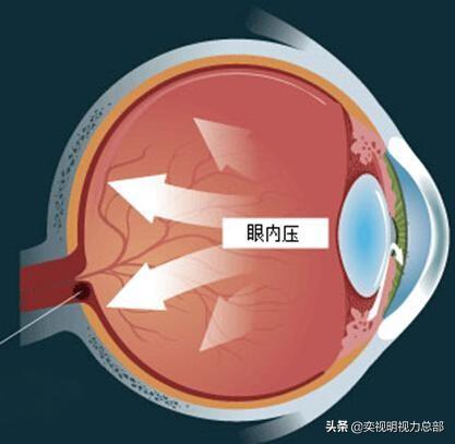 高度近视的人不适合做什么?-第3张图片 高度近视的人不适合做什么?-第3张图片