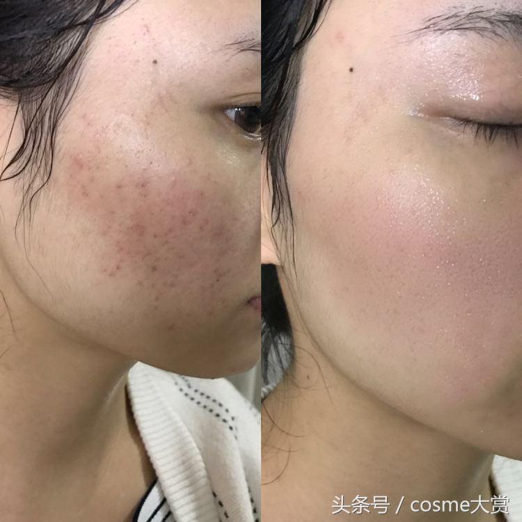 用舒肤佳洗脸好吗?-第1张图片 用舒肤佳洗脸好吗?-第1张图片