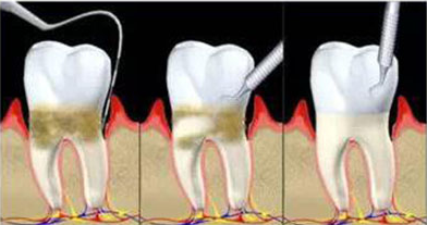 牙周炎能治好吗,牙周刮治的真实感受-第3张图片