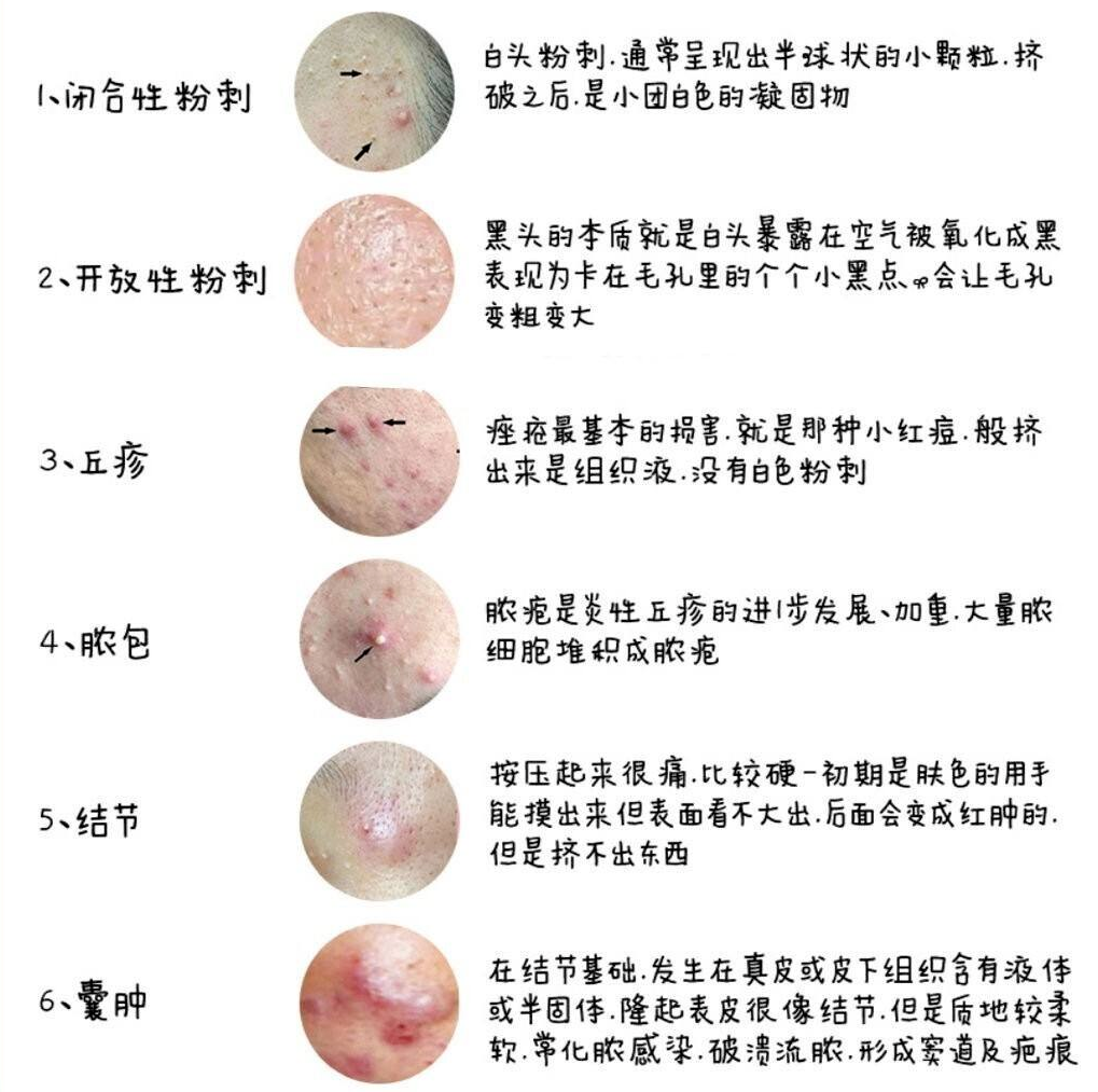 怎样去痘痘,快速去痘痘的小方法-第5张图片 怎样去痘痘,快速去痘痘的小方法-第5张图片