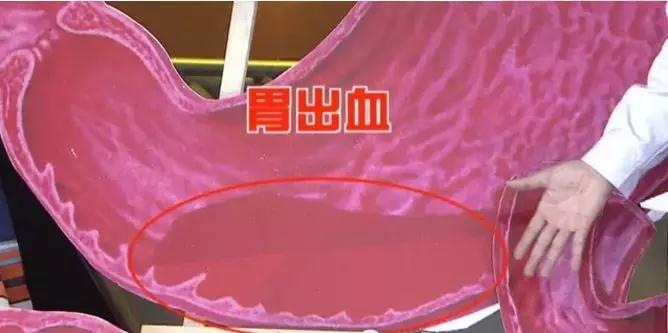 众所周知,多吃腌制食品会导致胃癌。多吃盐会导致胃癌吗?-第4张图片 众所周知,多吃腌制食品会导致胃癌。多吃盐会导致胃癌吗?-第4张图片