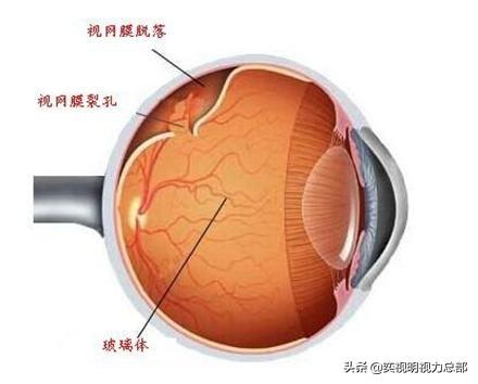 高度近视的人不适合做什么?-第2张图片 高度近视的人不适合做什么?-第2张图片