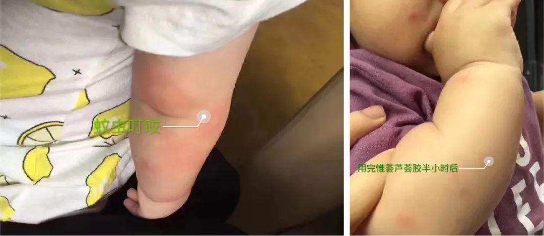 芦荟胶对痘痘和痘印有效果吗(每天晚上坚持涂芦荟胶的效果)-第23张图片 芦荟胶对痘痘和痘印有效果吗(每天晚上坚持涂芦荟胶的效果)-第23张图片