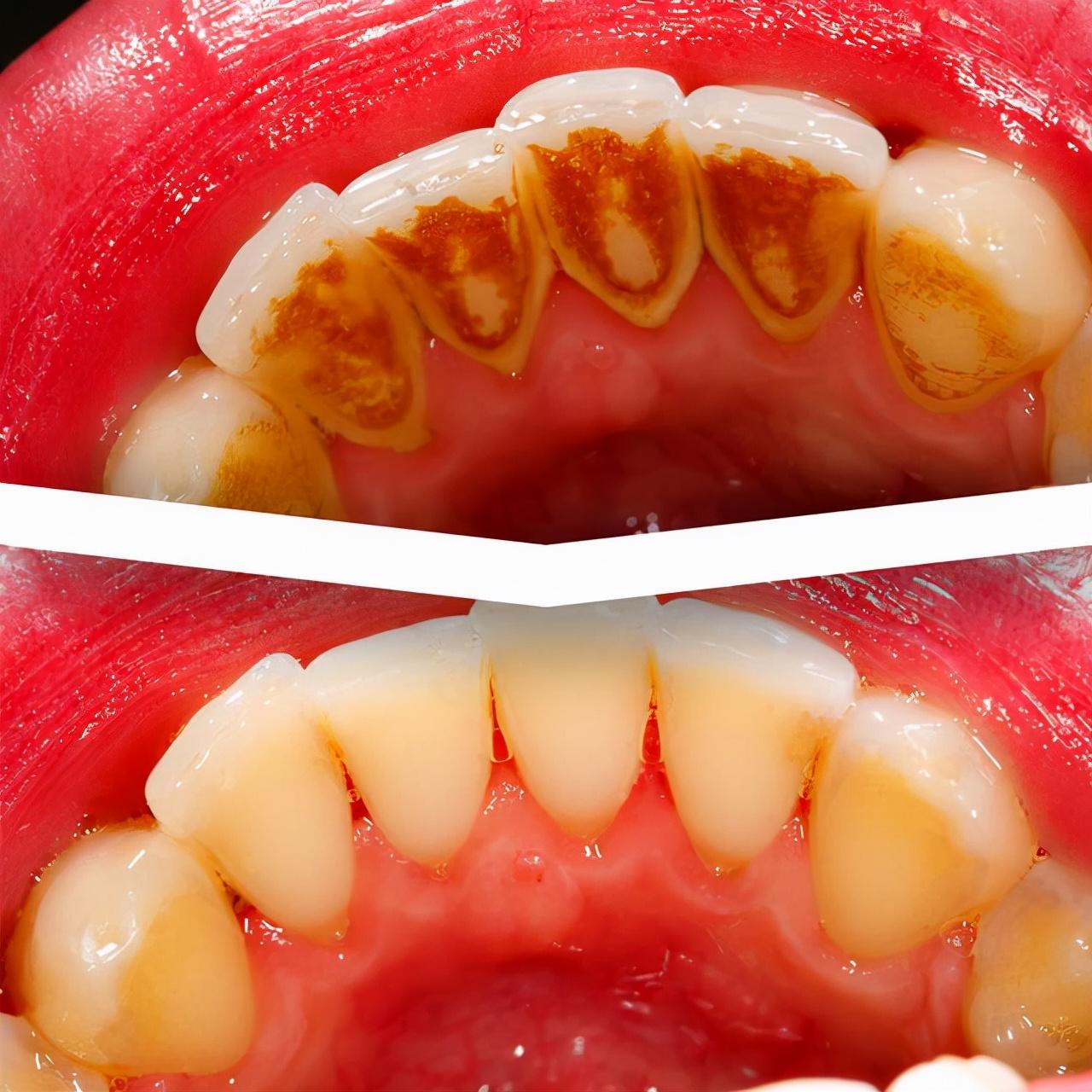 为什么人都后悔洗牙（哪些患者是不适合进行洗牙的）-第3张图片