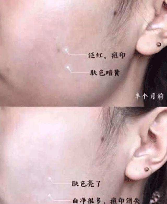 芦荟胶对痘痘和痘印有效果吗(每天晚上坚持涂芦荟胶的效果)-第19张图片 芦荟胶对痘痘和痘印有效果吗(每天晚上坚持涂芦荟胶的效果)-第19张图片