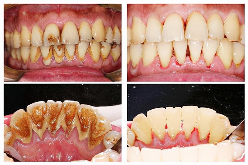 为什么人都后悔洗牙（哪些患者是不适合进行洗牙的）-第4张图片