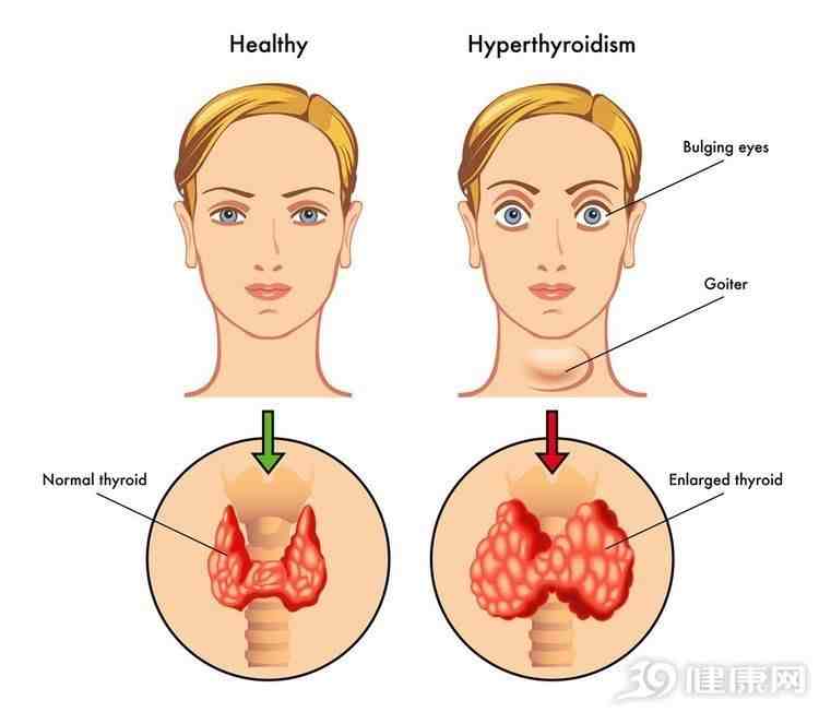 甲状腺有什么症状（甲状腺有问题，哪些症状很明显）-第3张图片
