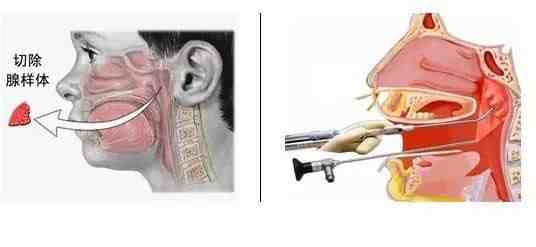 腺样体肥大是什么症状（腺样体为什么会肥大）-第3张图片