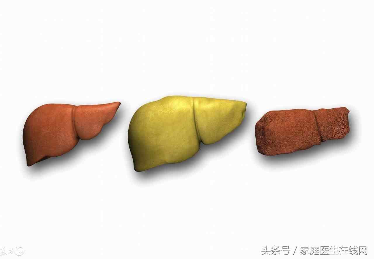 脂肪肝如何消除（检查出脂肪肝该怎么治）-第2张图片