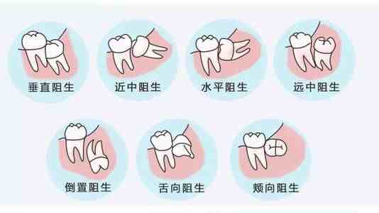 智齿什么时候长（智齿是什么时候开始长的）-第4张图片