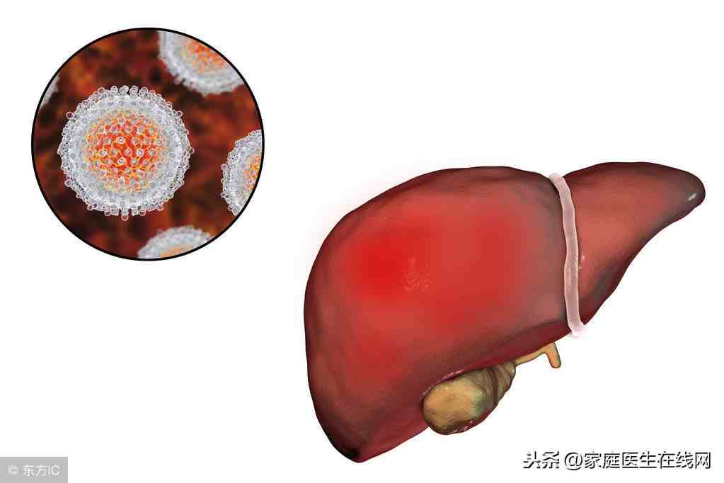 肝炎的症状有哪些（感染上肝炎会有什么表现）-第2张图片