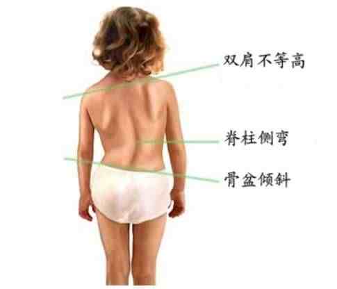 背背佳有用吗（孩子脊柱侧弯，戴背背佳有用吗？）-第2张图片