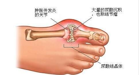 治疗痛风的偏方（专治痛风的偏方）-第3张图片