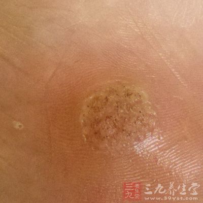 脚上起鸡眼怎么办（鸡眼的预防和治疗）-第18张图片