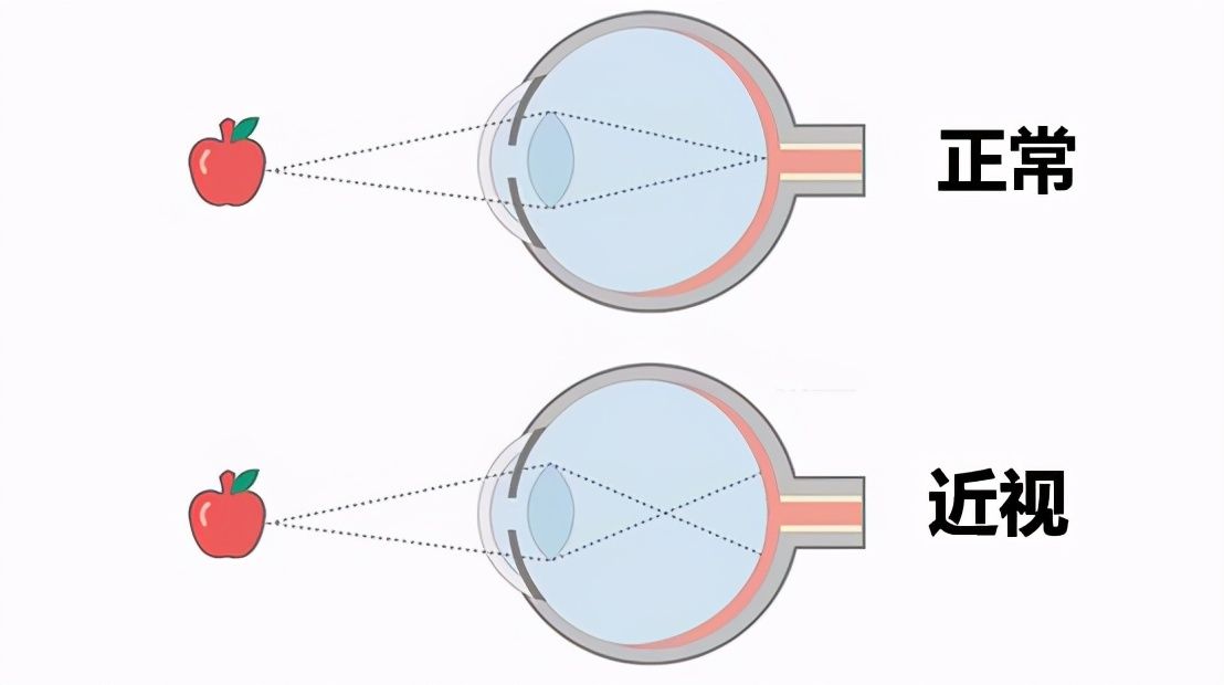 近视的危害（近视的危害您知道几个？）-第1张图片