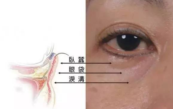 有泪沟怎么消除（3种方法快速去泪沟 ）-第2张图片