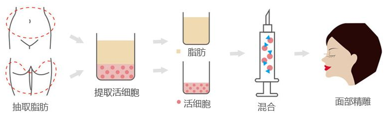 有泪沟怎么消除（3种方法快速去泪沟 ）-第5张图片