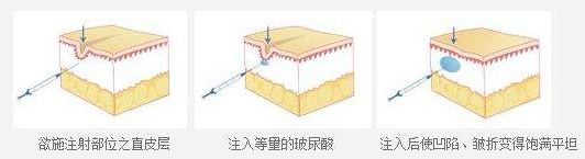 有泪沟怎么消除（3种方法快速去泪沟 ）-第4张图片