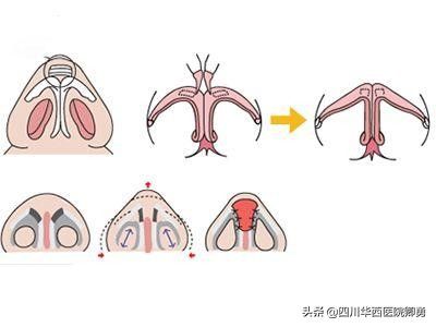 缩小鼻翼的方法（鼻翼缩小术三种常见方法）-第2张图片