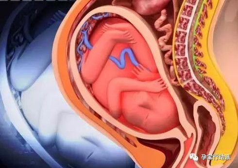 胎儿钙化（胎盘钙化怎么回事）-第3张图片