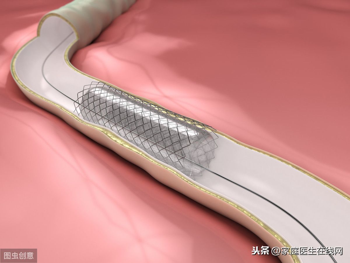 心脏支架手术的寿命（心脏支架术后一般能存活多少年？）-第2张图片