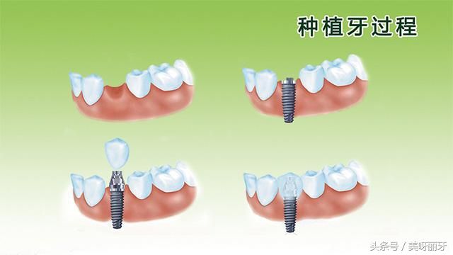 牙齿掉了能种植牙吗（牙掉了能否马上种植牙）-第2张图片