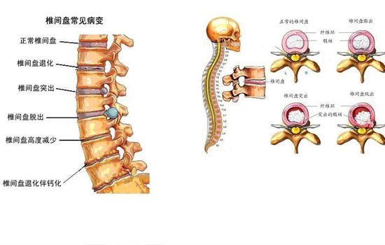 治疗腰椎间盘突出的好方法（腰椎间盘突出症的治疗方法全集）-第6张图片