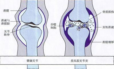 小腿骨膜炎的症状（小腿骨膜炎的主要症状有哪些？）-第4张图片
