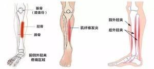 小腿骨膜炎的症状（小腿骨膜炎的主要症状有哪些？）-第3张图片