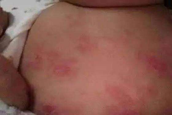 湿疹和热疹的区别图片(湿疹和热疹的区)-第4张图片 湿疹和热疹的区别图片(湿疹和热疹的区)-第4张图片