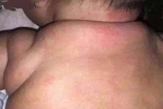 湿疹和热疹的区别图片(湿疹和热疹的区)-第5张图片 湿疹和热疹的区别图片(湿疹和热疹的区)-第5张图片