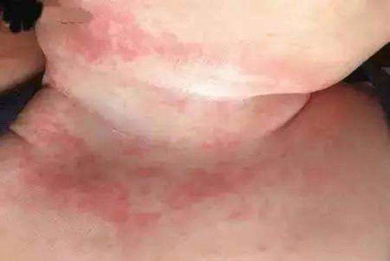 湿疹和热疹的区别图片(湿疹和热疹的区)-第8张图片 湿疹和热疹的区别图片(湿疹和热疹的区)-第8张图片
