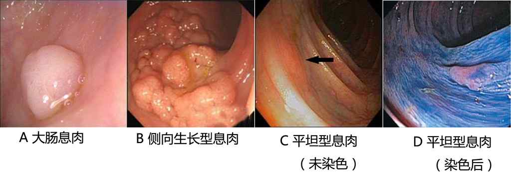 大肠息肉？（什么是大肠息肉？）-第2张图片