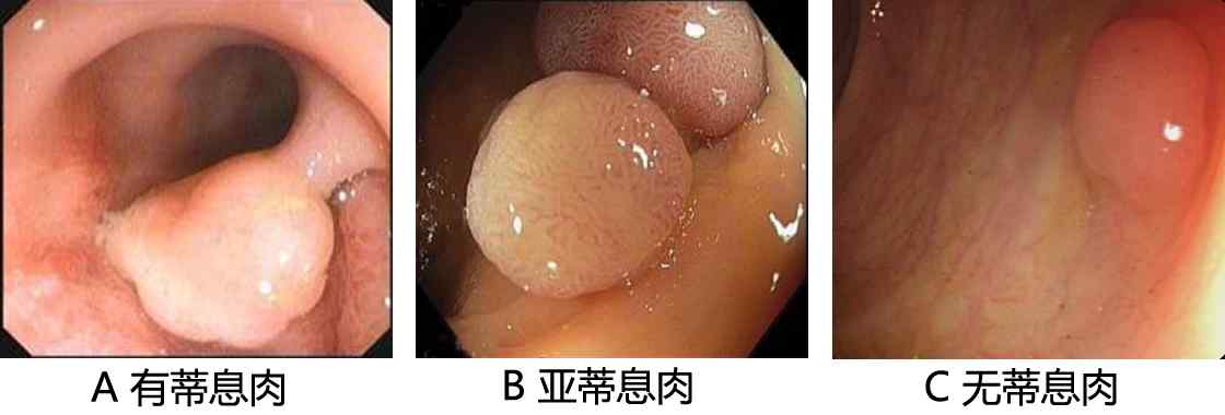 大肠息肉？（什么是大肠息肉？）-第3张图片