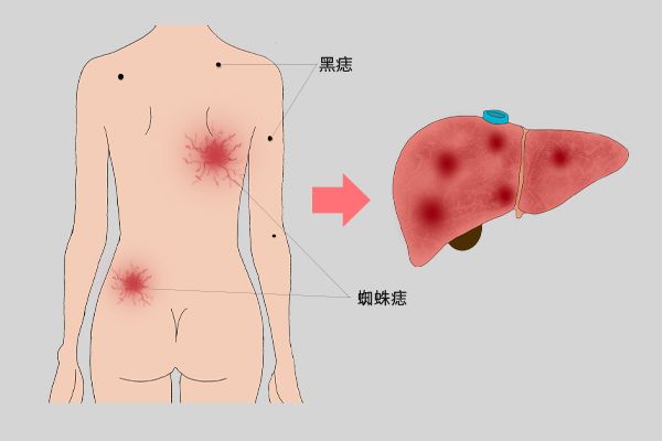 身上长小红点（皮肤上突然出现了很多小红点是怎么回事）-第4张图片