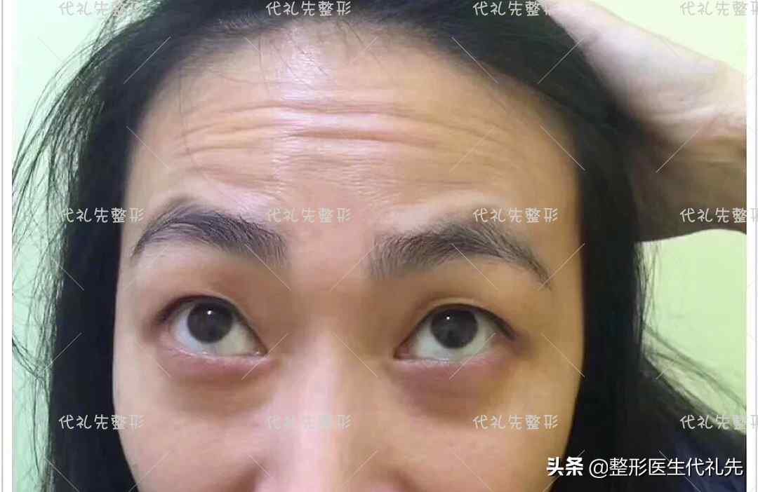 抬头纹怎么消？（有了抬头纹要怎么办？）-第1张图片