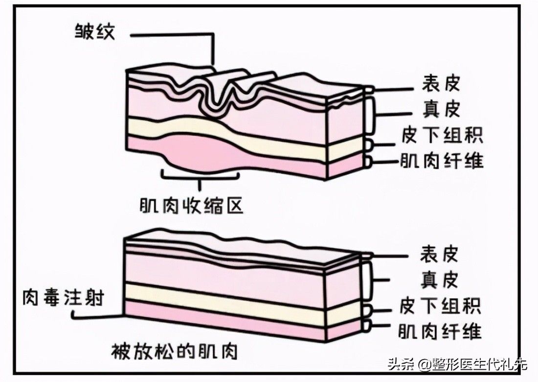 抬头纹怎么消？（有了抬头纹要怎么办？）-第2张图片