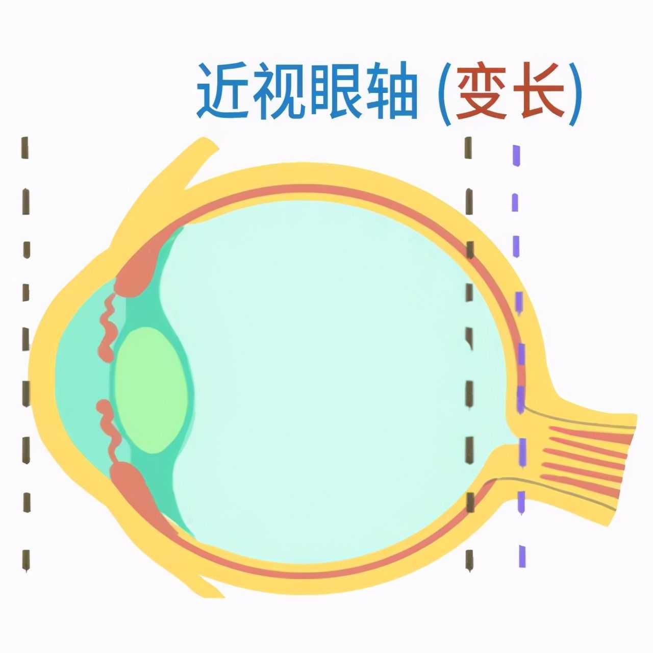 小孩近视眼怎么办(孩子近视了怎么办?)-第2张图片 小孩近视眼怎么办(孩子近视了怎么办?)-第2张图片