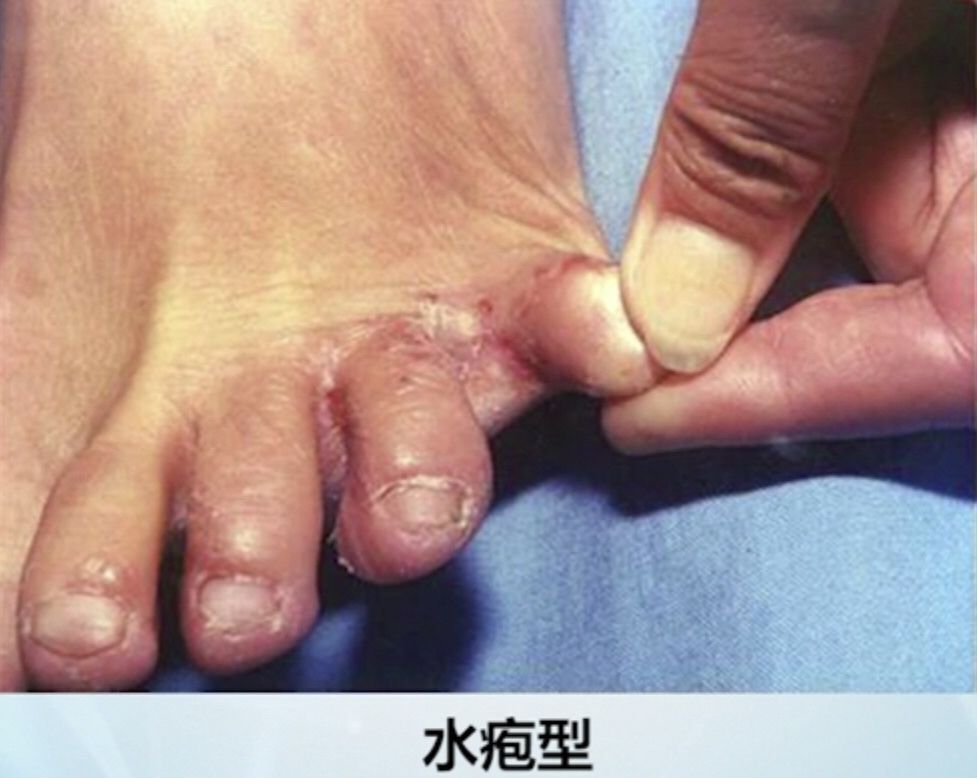 什么是香港脚（脚气为什么又叫香港脚？）-第4张图片