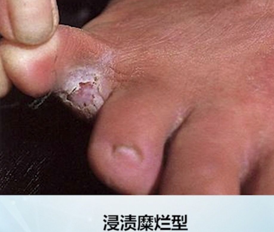 什么是香港脚（脚气为什么又叫香港脚？）-第6张图片
