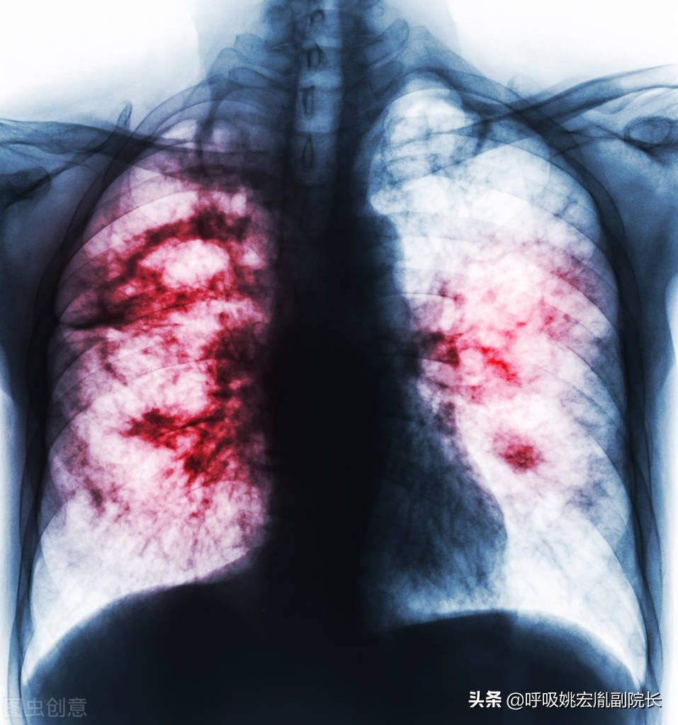 肺病的症状（肺病有哪些？）-第2张图片