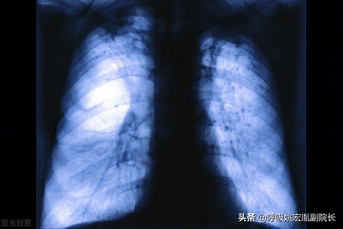 肺病的症状（肺病有哪些？）-第4张图片