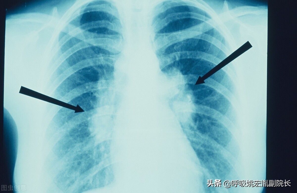 肺病的症状（肺病有哪些？）-第5张图片