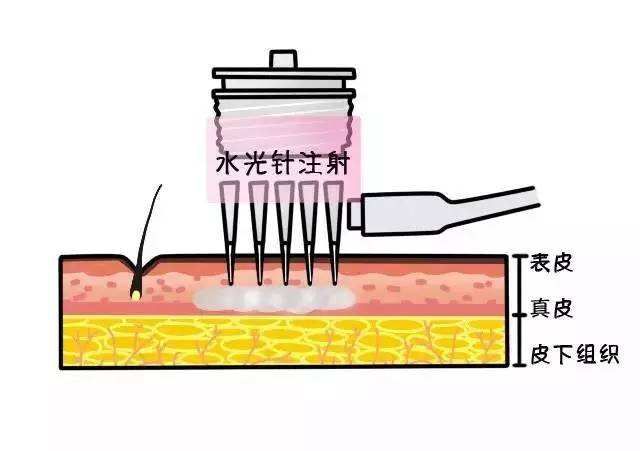 美白针有副作用吗（打美白针有什么副作用？）-第7张图片