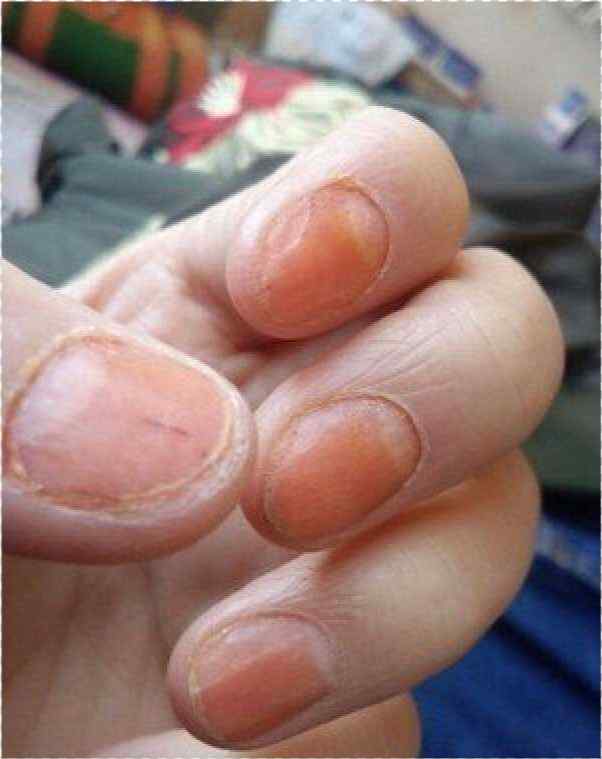 灰指甲的图片（关于灰指甲你知道多少呢？）-第6张图片