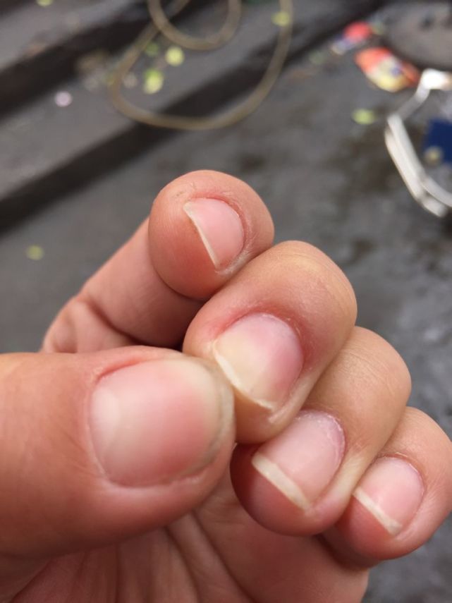 灰指甲的图片（关于灰指甲你知道多少呢？）-第3张图片