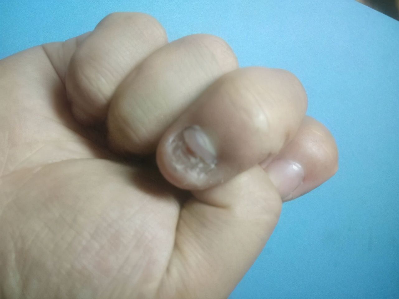 灰指甲的图片（关于灰指甲你知道多少呢？）-第4张图片