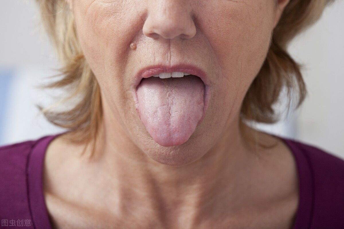 舌癌的症状（什么是舌癌？）-第1张图片